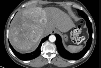 Large-Tumor.jpg